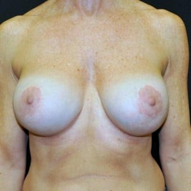 Breast Revision/Correction Before & After Gallery - Patient 270004 - Image 2