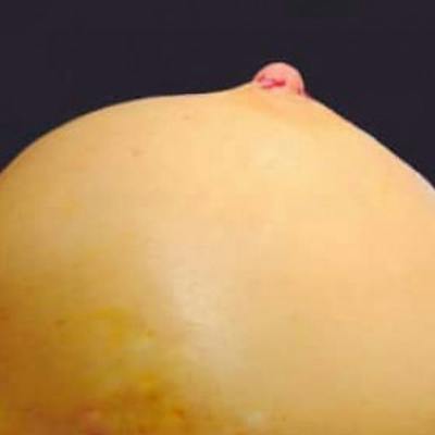 Nipple Reduction Before & After Gallery - Patient 735711 - Image 2