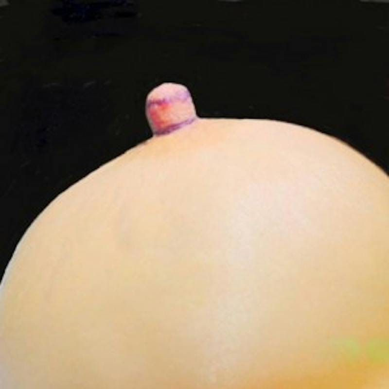 Nipple Reduction Before & After Gallery - Patient 735711 - Image 3