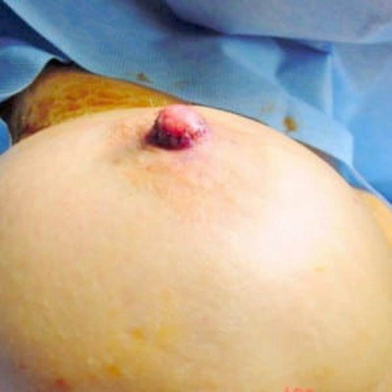 Nipple Reduction Before & After Gallery - Patient 735711 - Image 4