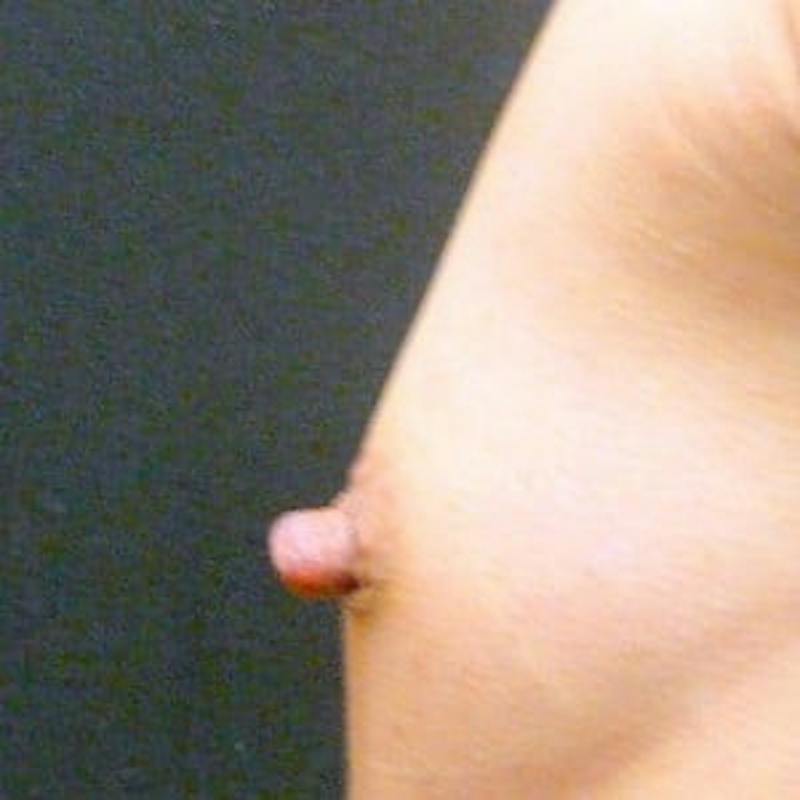 Nipple Reduction Before & After Gallery - Patient 237800 - Image 1