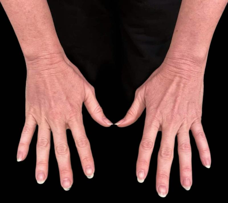 Alloclae Before & After Gallery - Patient 268855 - Image 1