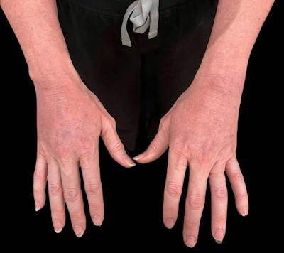 Alloclae Before & After Gallery - Patient 268855 - Image 2