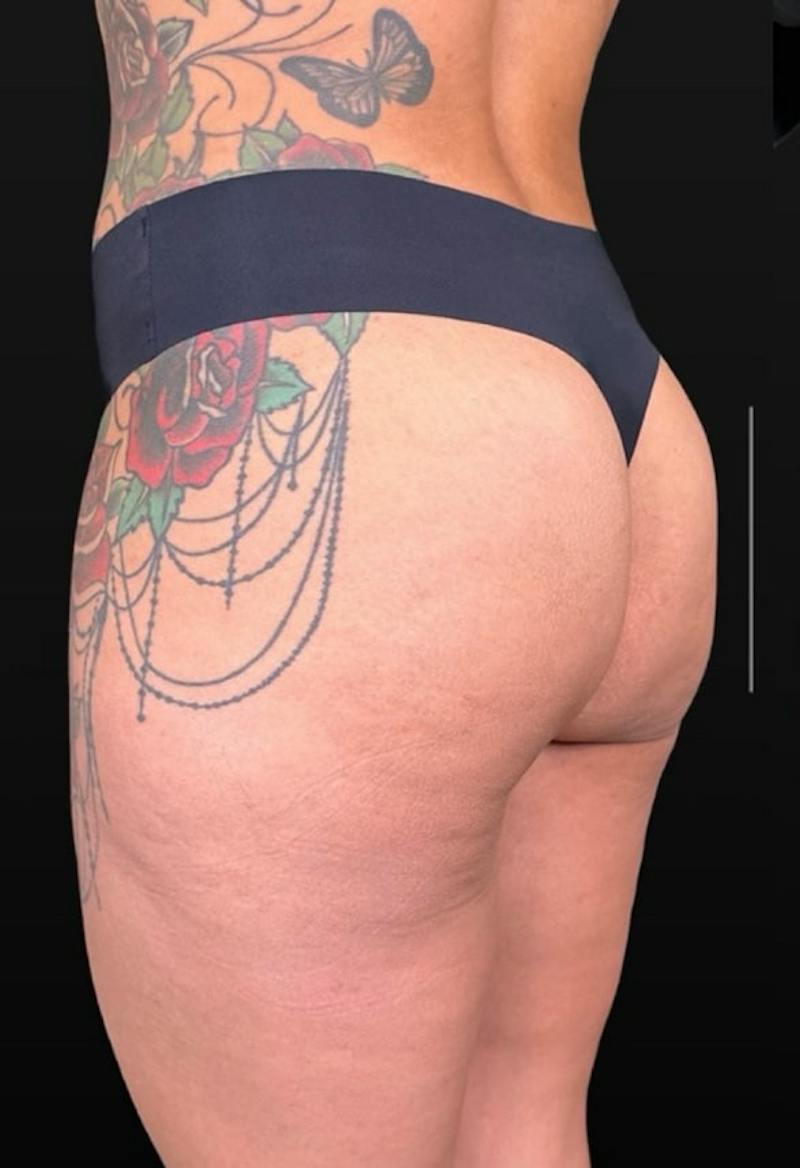 Alloclae Before & After Gallery - Patient 298539 - Image 1