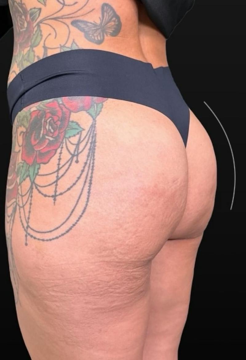 Alloclae Before & After Gallery - Patient 298539 - Image 2