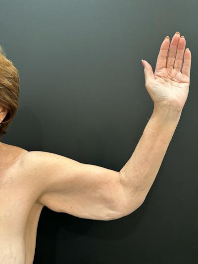Arm Lift Before & After Gallery - Patient 251048 - Image 1