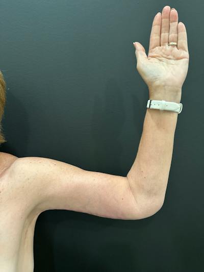 Arm Lift Before & After Gallery - Patient 251048 - Image 2