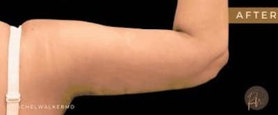 Arm Lift Before & After Gallery - Patient 321578 - Image 2