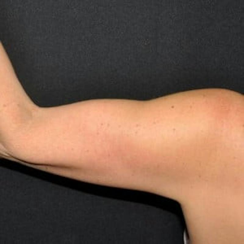 Arm Lift Before & After Gallery - Patient 319752 - Image 2