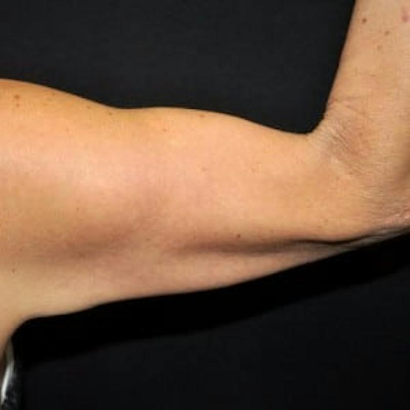 Arm Lift Before & After Gallery - Patient 319752 - Image 3