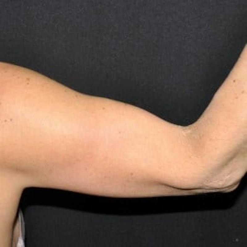 Arm Lift Before & After Gallery - Patient 319752 - Image 4