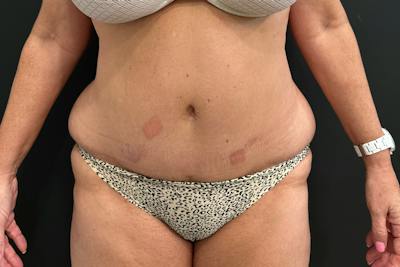Excess Skin Removal Before & After Gallery - Patient 202764 - Image 1