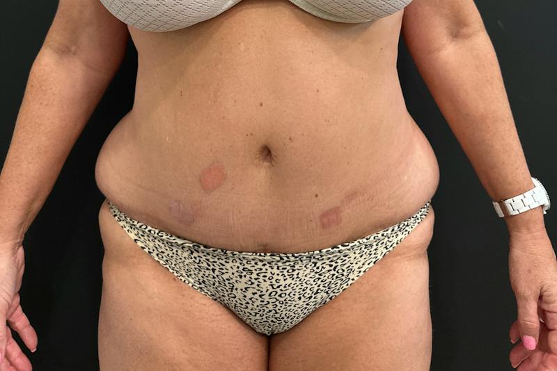 SAFElipo Before & After Gallery - Patient 243637 - Image 1