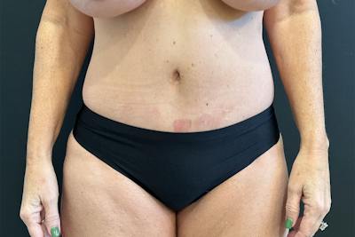 Excess Skin Removal Before & After Gallery - Patient 202764 - Image 2