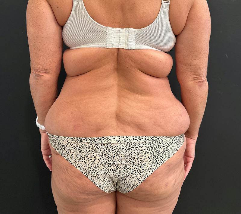 SAFElipo Before & After Gallery - Patient 243637 - Image 3