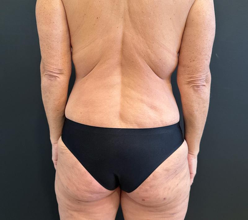 SAFElipo Before & After Gallery - Patient 243637 - Image 4