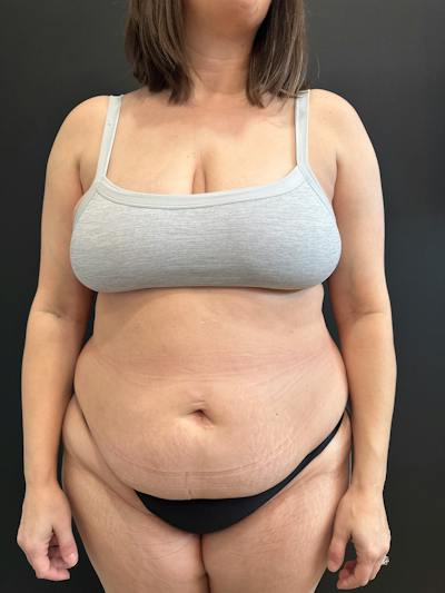 Extended Abdominoplasty Before & After Gallery - Patient 240753 - Image 1