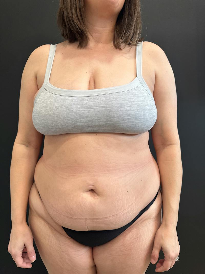 Extended Abdominoplasty Before & After Gallery - Patient 240753 - Image 1