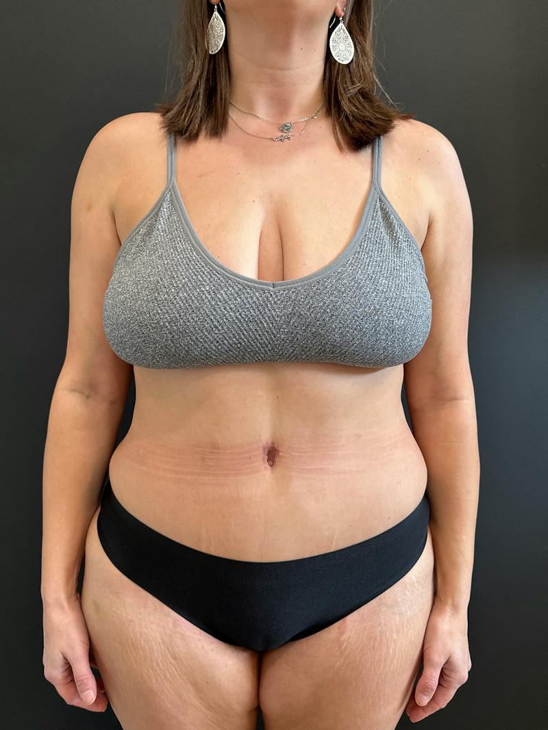 Extended Abdominoplasty Before & After Gallery - Patient 240753 - Image 2