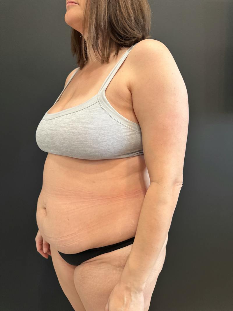 Extended Abdominoplasty Before & After Gallery - Patient 240753 - Image 3