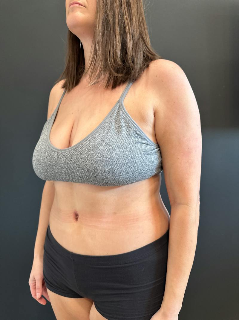 Extended Abdominoplasty Before & After Gallery - Patient 240753 - Image 4