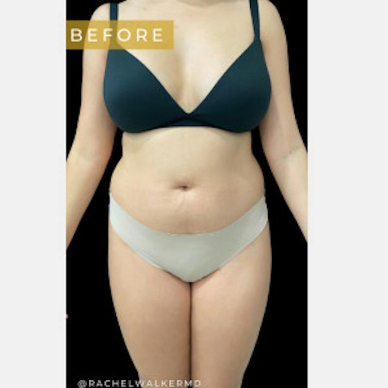 SAFElipo Before & After Gallery - Patient 176809 - Image 1
