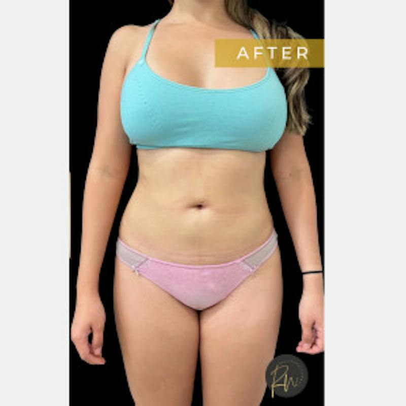 SAFElipo Before & After Gallery - Patient 176809 - Image 2