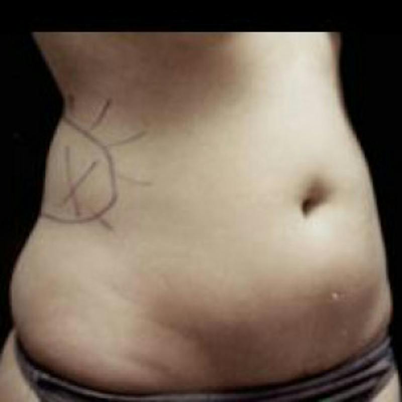 SAFElipo Before & After Gallery - Patient 190433 - Image 3