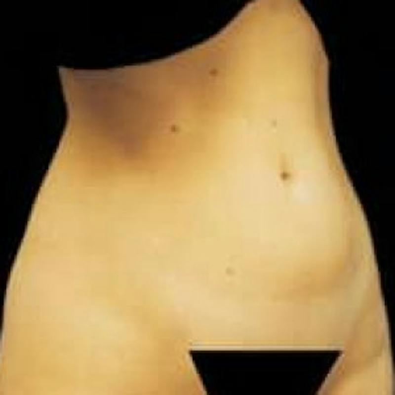 SAFElipo Before & After Gallery - Patient 355217 - Image 1
