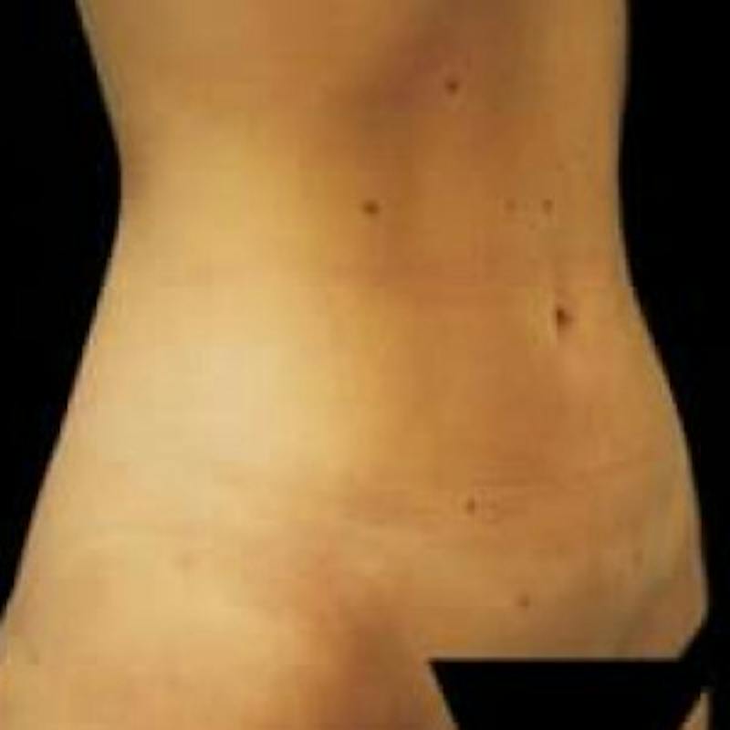 SAFElipo Before & After Gallery - Patient 355217 - Image 2