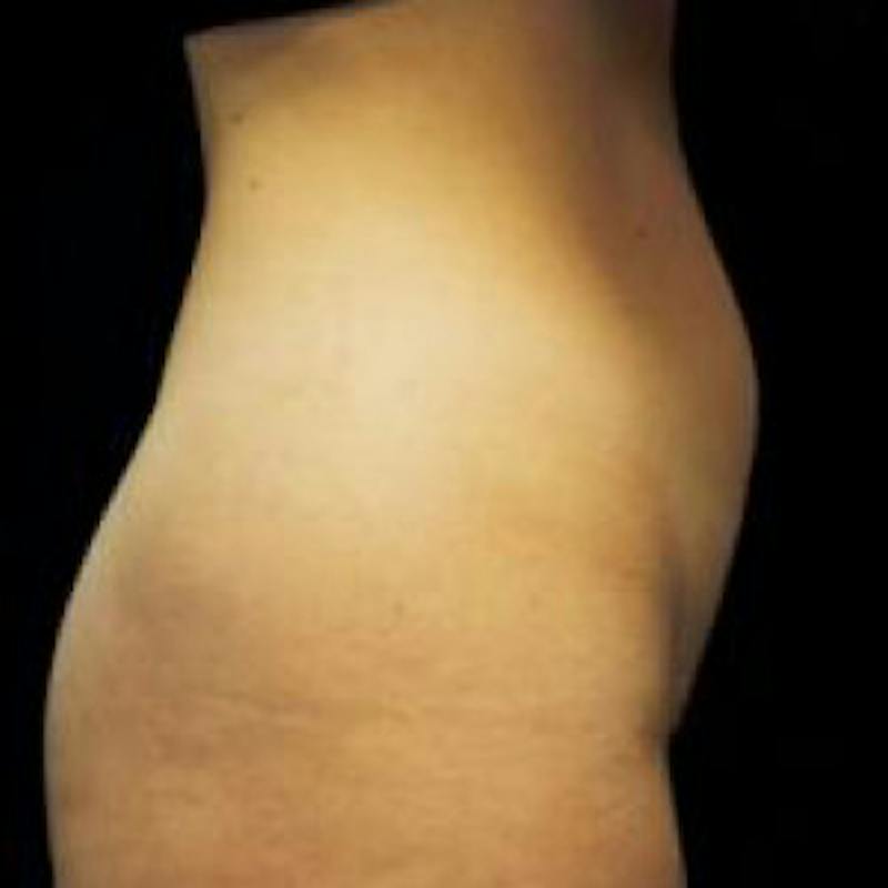 SAFElipo Before & After Gallery - Patient 355217 - Image 3