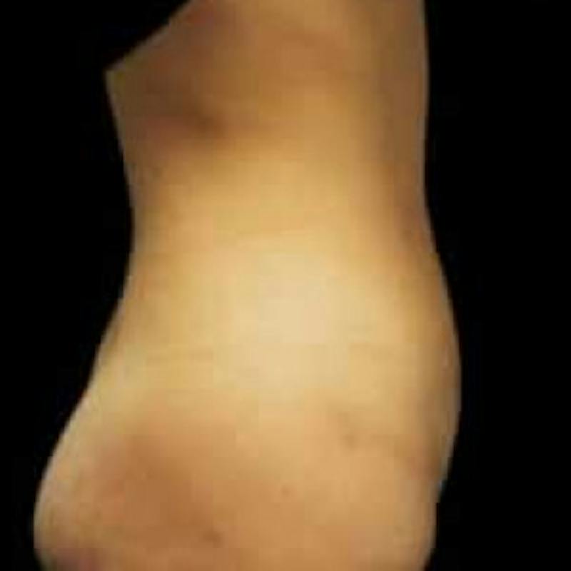 SAFElipo Before & After Gallery - Patient 355217 - Image 4
