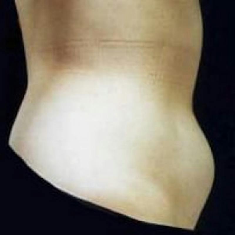 SAFElipo Before & After Gallery - Patient 261090 - Image 1