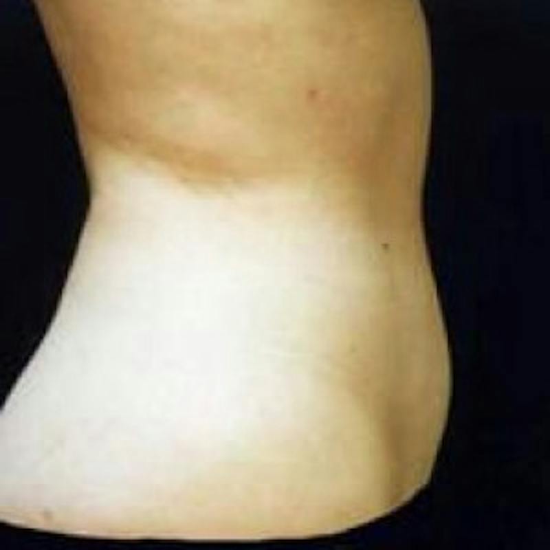 SAFElipo Before & After Gallery - Patient 261090 - Image 2