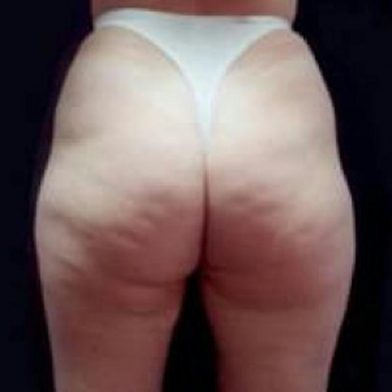 SAFElipo Before & After Gallery - Patient 420466 - Image 1