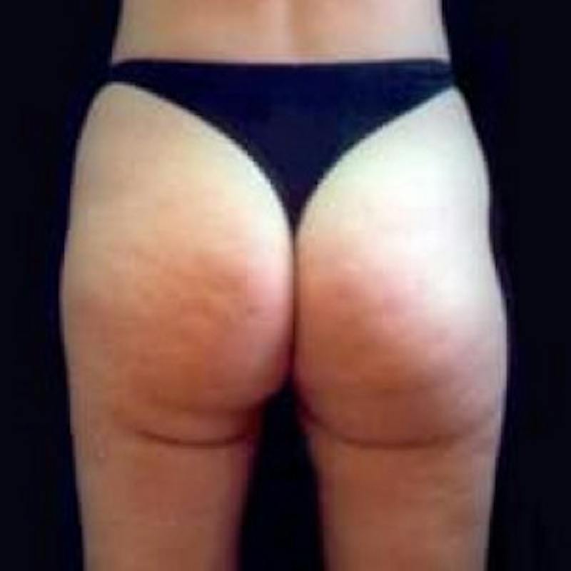 SAFElipo Before & After Gallery - Patient 420466 - Image 2
