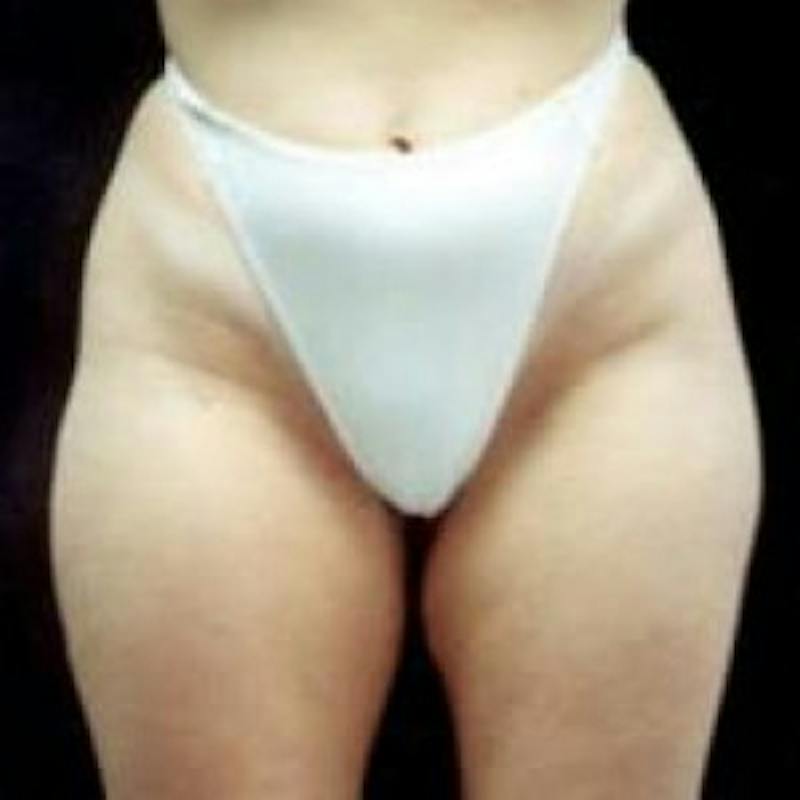 SAFElipo Before & After Gallery - Patient 420466 - Image 3