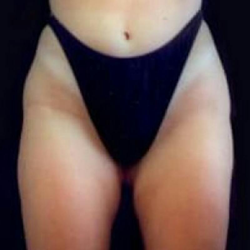 SAFElipo Before & After Gallery - Patient 420466 - Image 4