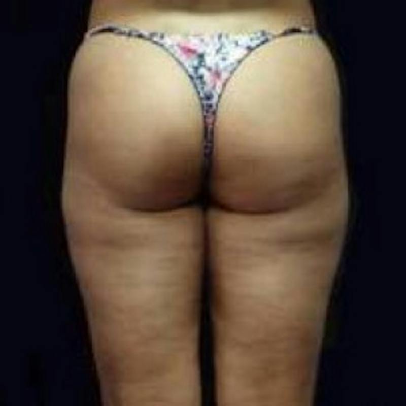 SAFElipo Before & After Gallery - Patient 654655 - Image 1