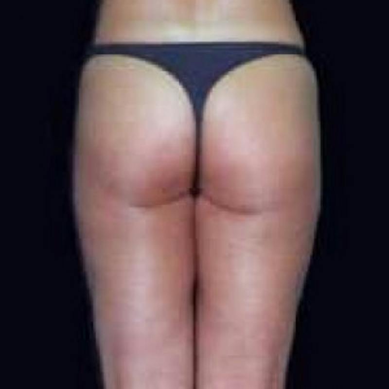 SAFElipo Before & After Gallery - Patient 654655 - Image 2
