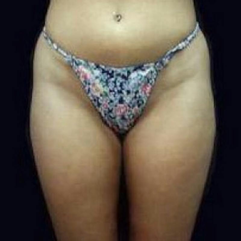 SAFElipo Before & After Gallery - Patient 654655 - Image 3