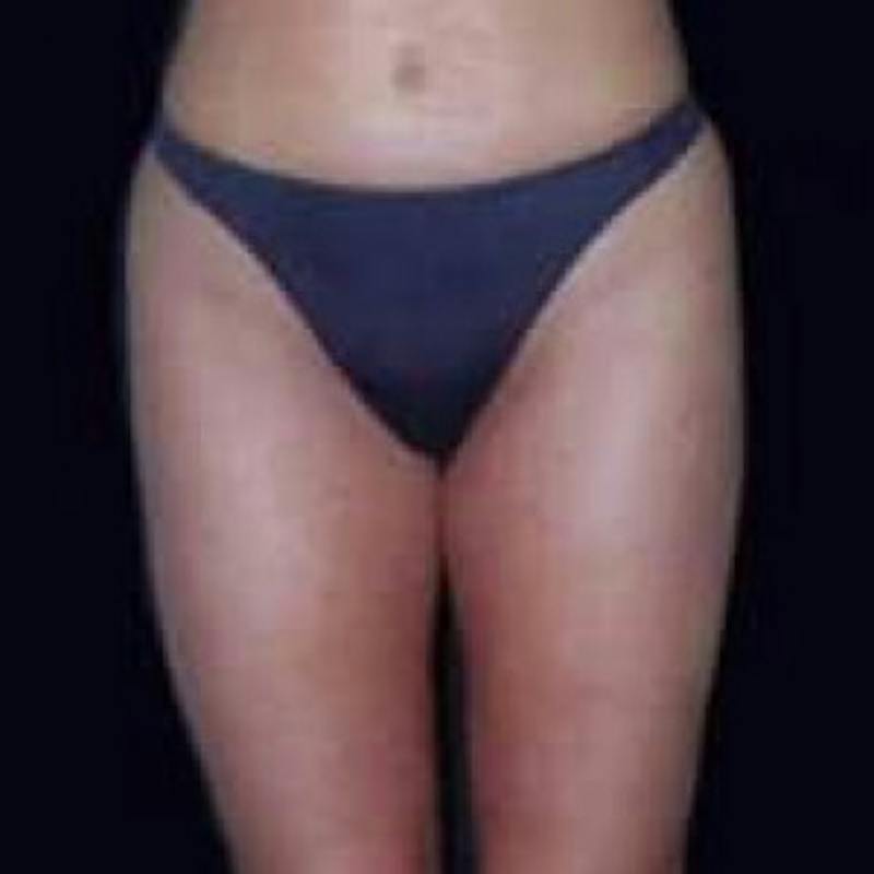 SAFElipo Before & After Gallery - Patient 654655 - Image 4
