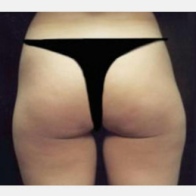 SAFElipo Before & After Gallery - Patient 631983 - Image 1