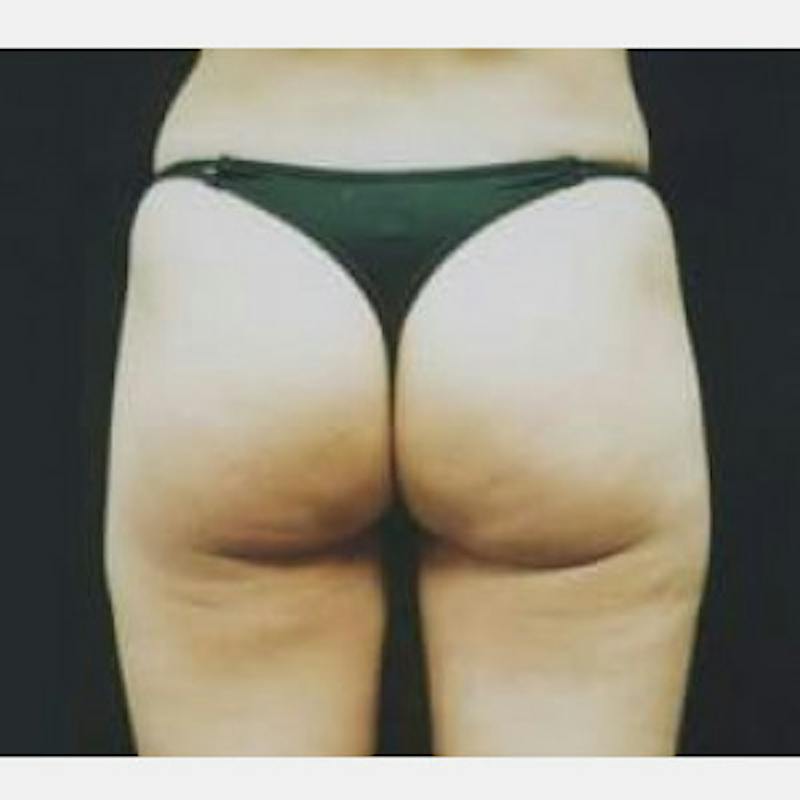 SAFElipo Before & After Gallery - Patient 631983 - Image 2