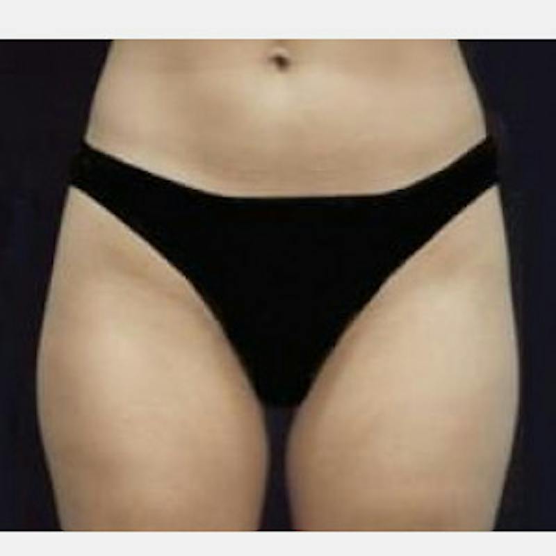SAFElipo Before & After Gallery - Patient 631983 - Image 3