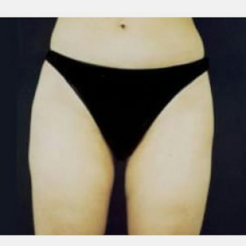 SAFElipo Before & After Gallery - Patient 631983 - Image 4