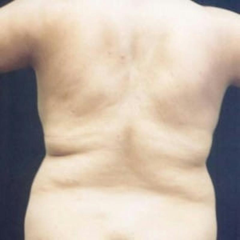 SAFElipo Before & After Gallery - Patient 386075 - Image 1