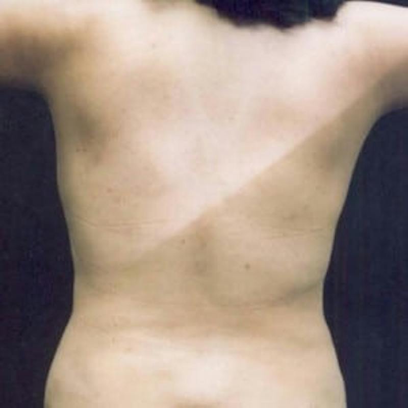 SAFElipo Before & After Gallery - Patient 386075 - Image 2