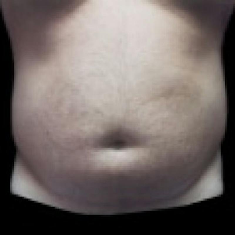 SAFElipo Before & After Gallery - Patient 208761 - Image 1