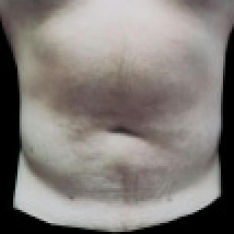 SAFElipo Before & After Gallery - Patient 208761 - Image 2